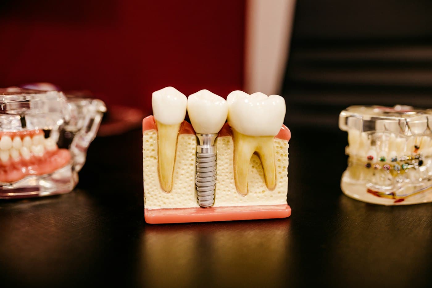 Dental implant education model
